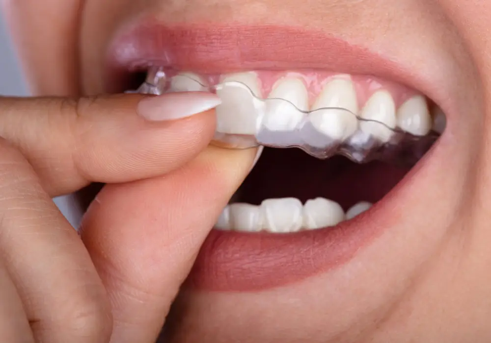 Clear Aligners & Braces at Subash Dental Care Chennai