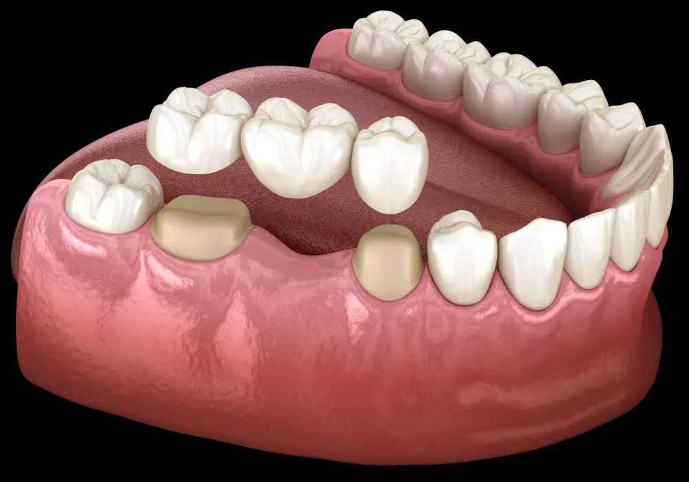 Crowns & Bridges at Subash Dental Care Chennai