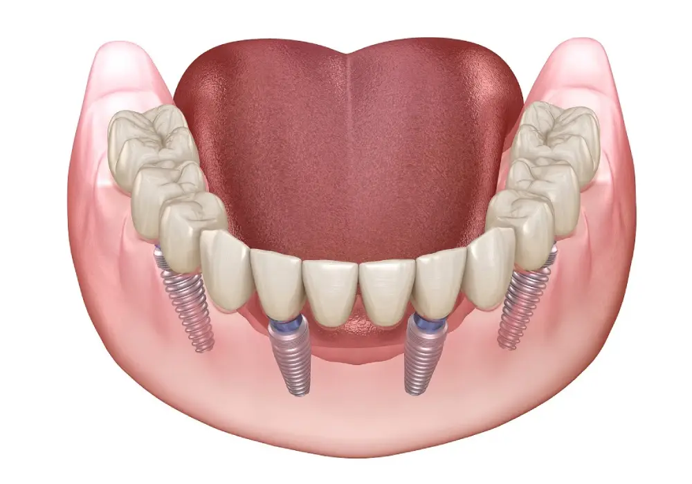 Full Mouth Rehabilitation at Subash Dental Care Chennai