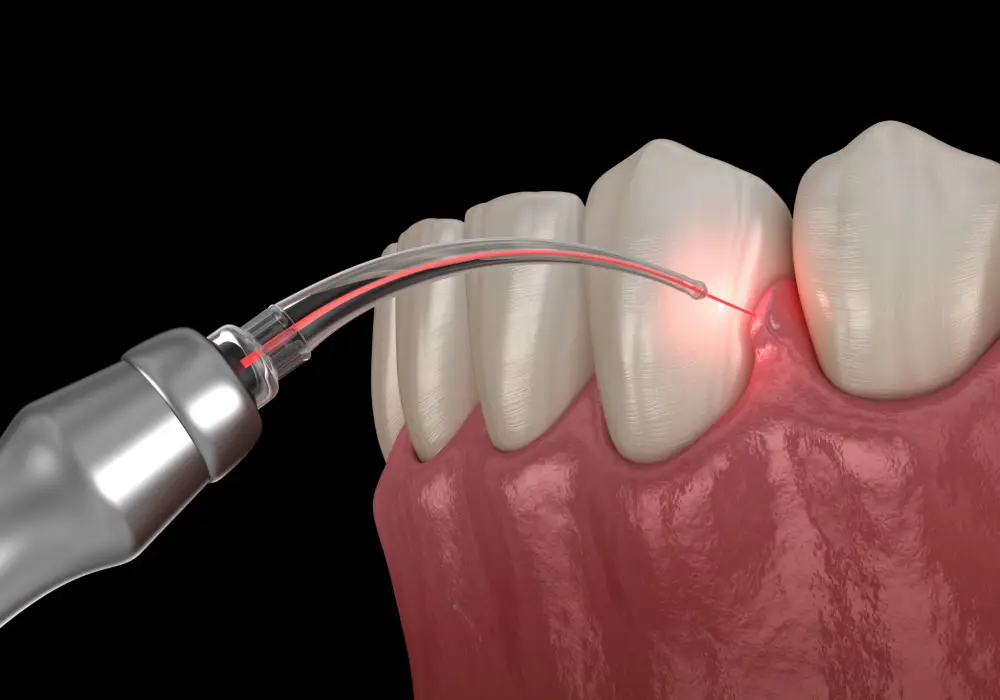 Laser Dentistry at Subash Dental Care Chennai