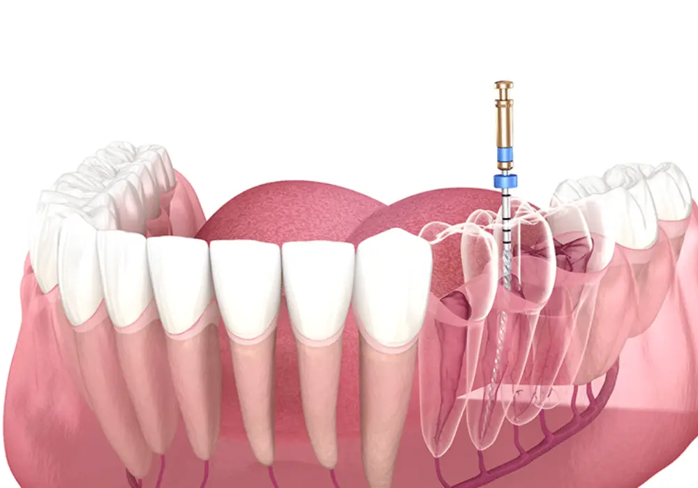 Root Canal Treatment at Subash Dental Care Chennai