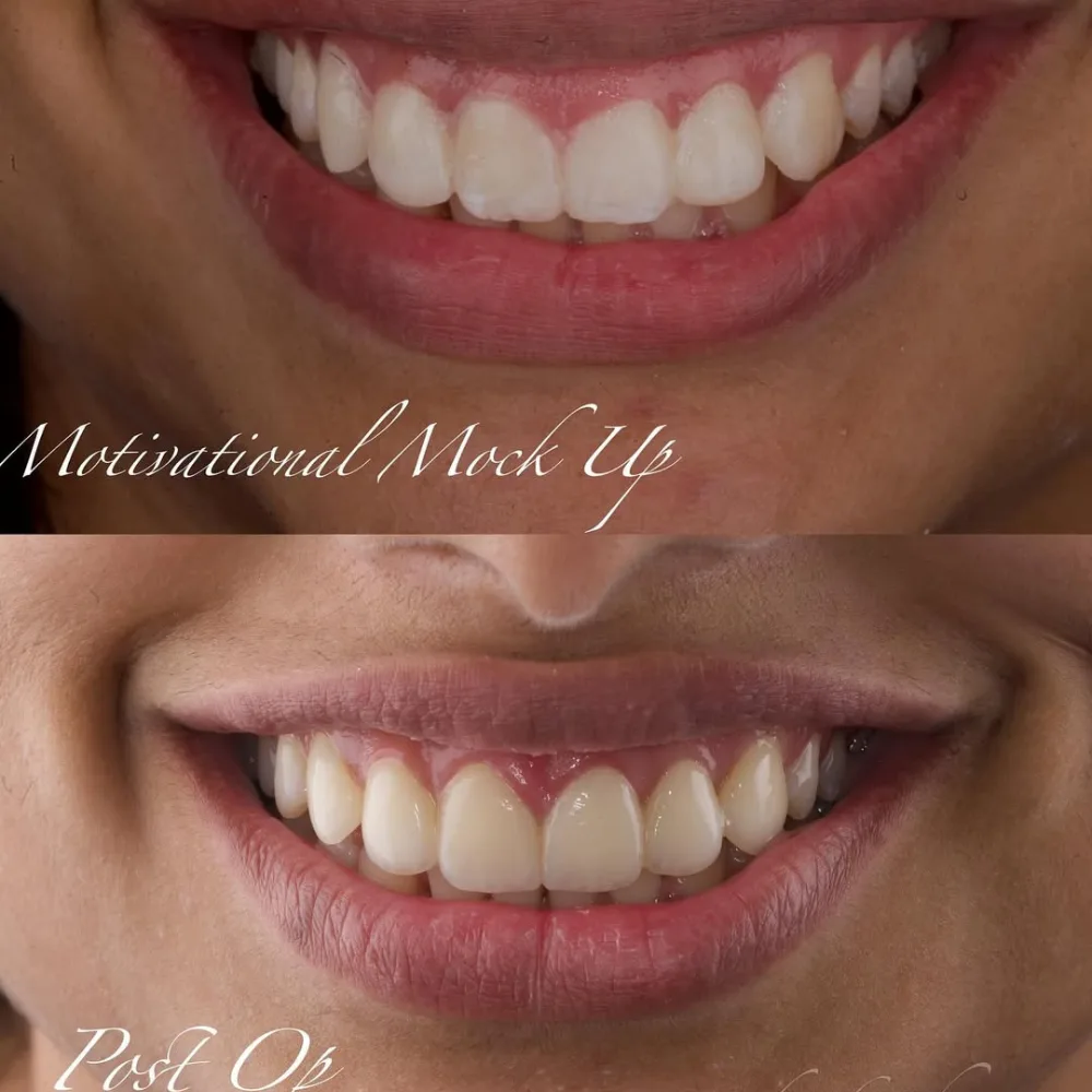 Smile Makeover treatment in Maduravoyal