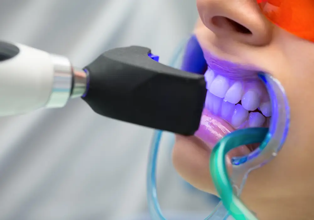 Teeth Whitening at Subash Dental Care Chennai