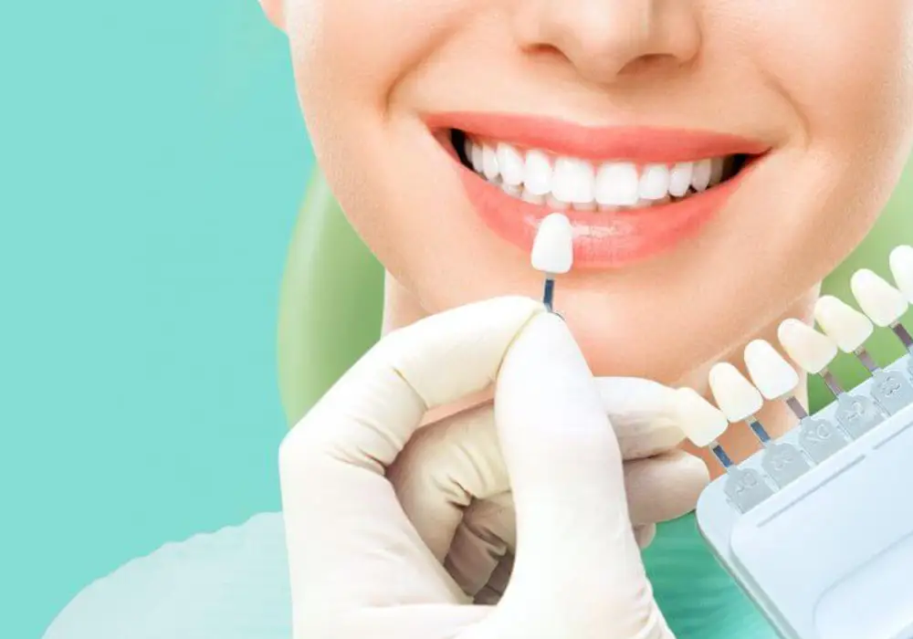 Veneers & Laminates at Subash Dental Care Chennai