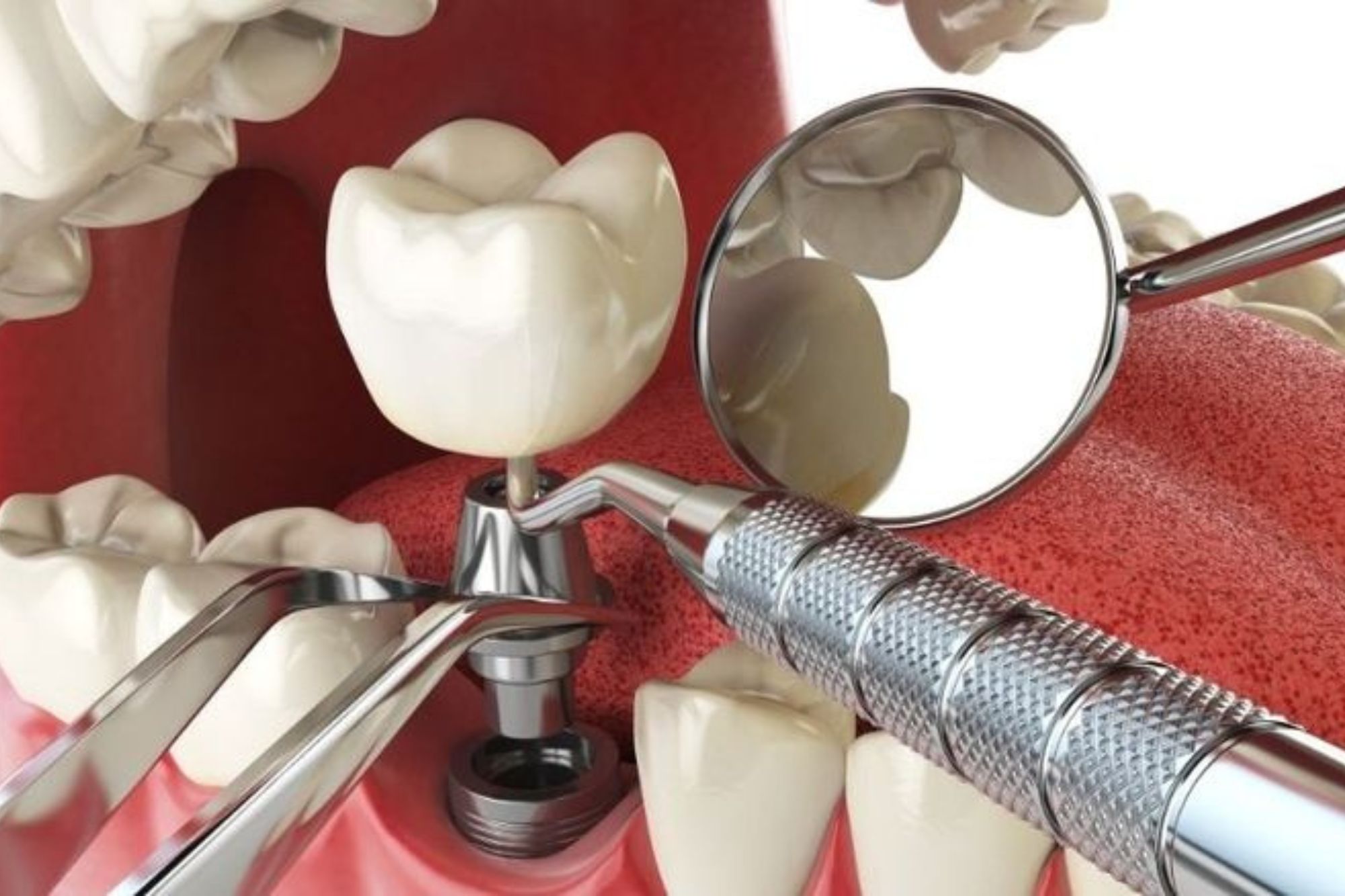 Dental Implants at Subash Dental Care Chennai
